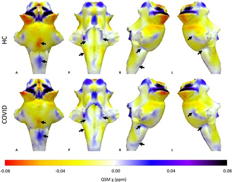 Quantitative susceptibility mapping at 7 T in COVID-19: brainstem effects and outcome associations
