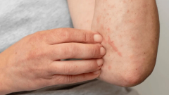 Jalisco suma 122 casos de sarampión, segundo estado con más casos; llaman a vacunarse