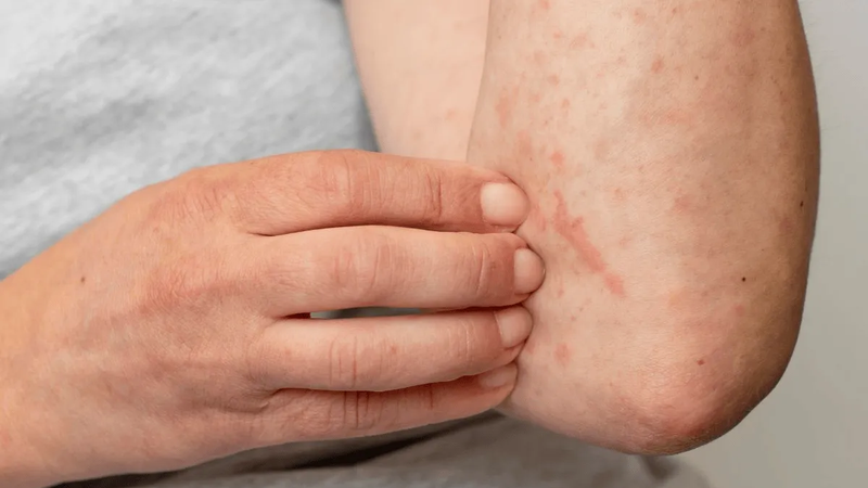 Jalisco suma 122 casos de sarampión, segundo estado con más casos; llaman a vacunarse