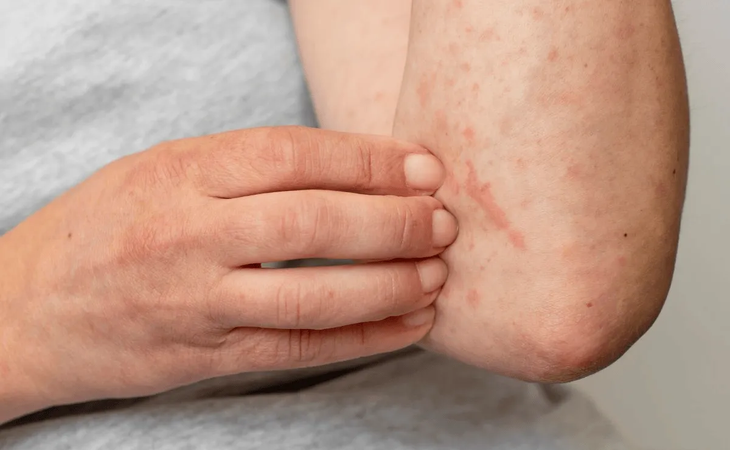 Jalisco suma 122 casos de sarampión, segundo estado con más casos; llaman a vacunarse