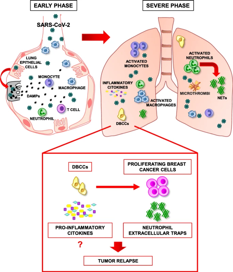 COVID-19: a potential driver of immune-mediated breast cancer recurrence?