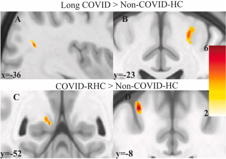 Altered brain tissue microstructure and neurochemical profiles in long COVID and recovered COVID-19 individuals: A multimodal MRI study