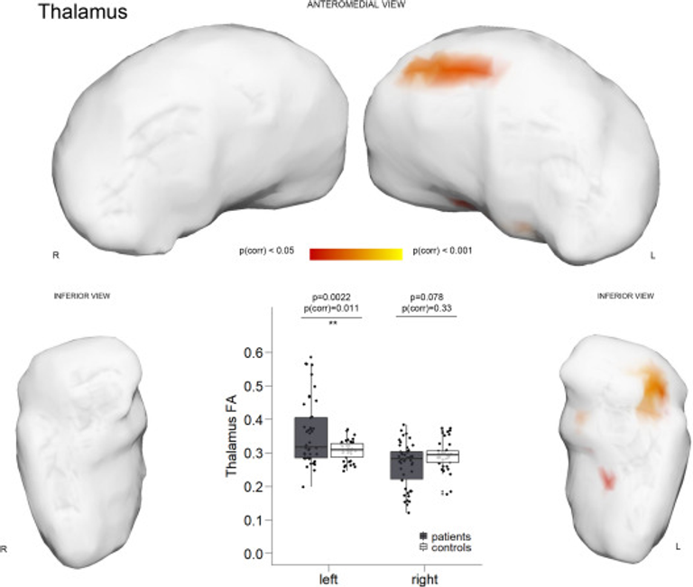Structural brain changes in patients with post-COVID fatigue: a prospective observational study