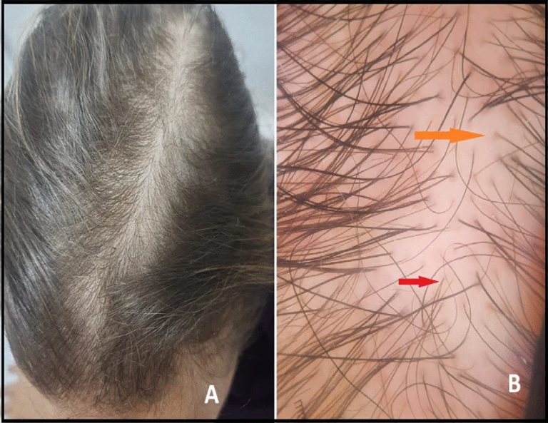 Hair disorders associated with post-COVID-19 infection in females: a cross-sectional study