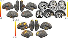 SARS-CoV-2 is associated with changes in brain structure in UK Biobank