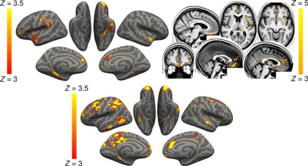 SARS-CoV-2 is associated with changes in brain structure in UK Biobank