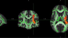 Microstructural brain abnormalities, fatigue, and cognitive dysfunction after mild COVID-19