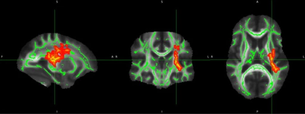 Microstructural brain abnormalities, fatigue, and cognitive dysfunction after mild COVID-19