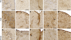 Hamsters with long COVID present distinct transcriptomic profiles associated with neurodegenerative processes in brainstem