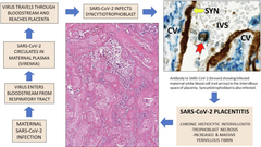 SARS-CoV-2 placentitis, stillbirth, and maternal COVID-19 vaccination: clinical–pathologic correlations
