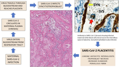 SARS-CoV-2 placentitis, stillbirth, and maternal COVID-19 vaccination: clinical–pathologic correlations
