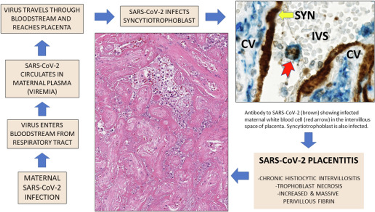 SARS-CoV-2 placentitis, stillbirth, and maternal COVID-19 vaccination: clinical–pathologic correlations
