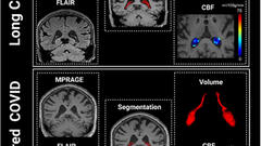 Choroid plexus alterations in long COVID and their associations with Alzheimer's disease risks