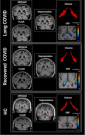 Choroid plexus alterations in long COVID and their associations with Alzheimer's disease risks