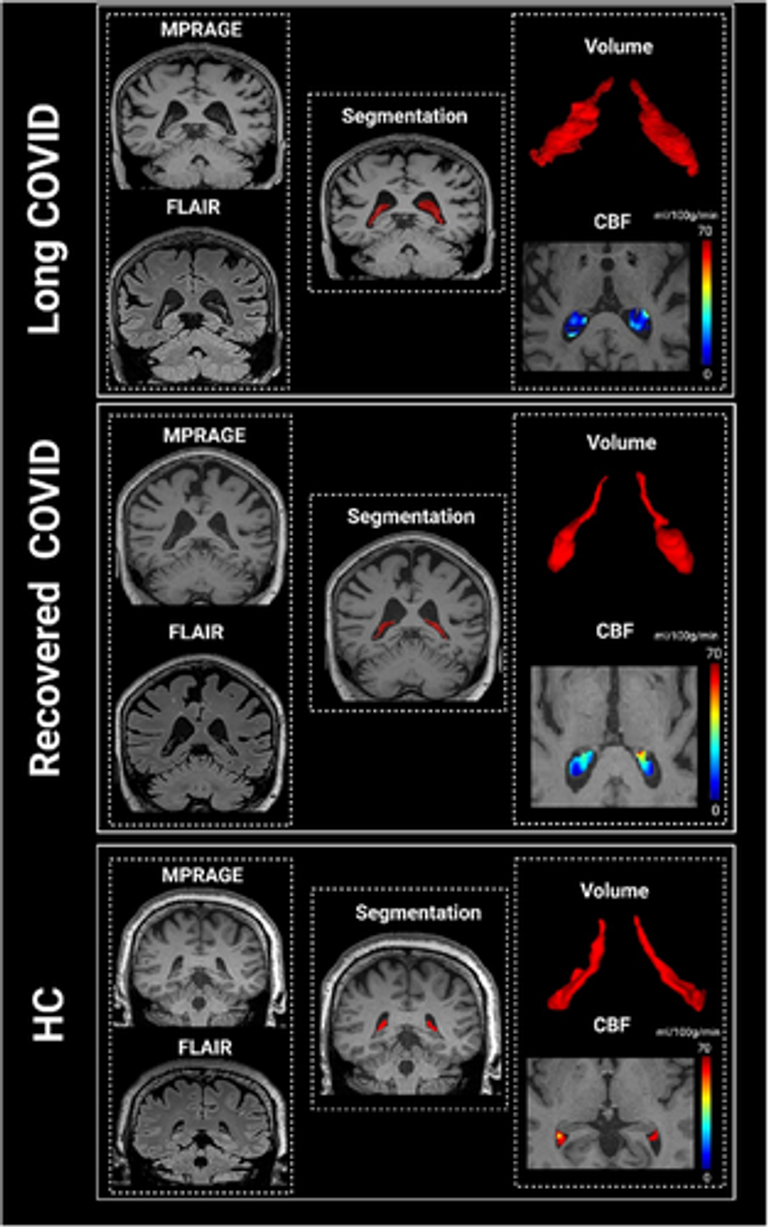 Choroid plexus alterations in long COVID and their associations with Alzheimer's disease risks