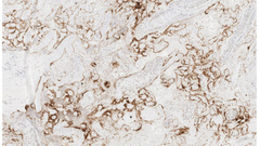 Stillbirth after COVID-19 in Unvaccinated Mothers Can Result from SARS-CoV-2 Placentitis, Placental Insufficiency, and Hypoxic Ischemic Fetal Demise, Not Direct Fetal Infection: Potential Role of Maternal Vaccination in Pregnancy