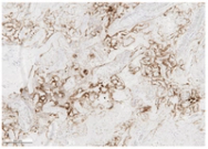 Stillbirth after COVID-19 in Unvaccinated Mothers Can Result from SARS-CoV-2 Placentitis, Placental Insufficiency, and Hypoxic Ischemic Fetal Demise, Not Direct Fetal Infection: Potential Role of Maternal Vaccination in Pregnancy