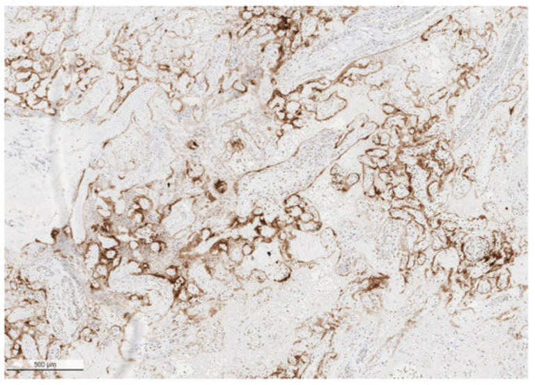 Stillbirth after COVID-19 in Unvaccinated Mothers Can Result from SARS-CoV-2 Placentitis, Placental Insufficiency, and Hypoxic Ischemic Fetal Demise, Not Direct Fetal Infection: Potential Role of Maternal Vaccination in Pregnancy