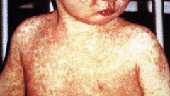 The CDC embraces bogus claims of autism-vaccine links