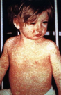 The CDC embraces bogus claims of autism-vaccine links