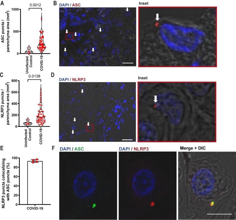 Pulmonary inflammation and viral replication define distinct clinical outcomes in fatal cases of COVID-19