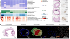 SARS-CoV-2 infection triggers pro-atherogenic inflammatory responses in human coronary vessels