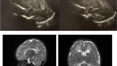 Cranial ultrasonographic findings in newborns exposed to SARS-CoV-2: a single-centre cross-sectional analysis