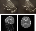 Cranial ultrasonographic findings in newborns exposed to SARS-CoV-2: a single-centre cross-sectional analysis