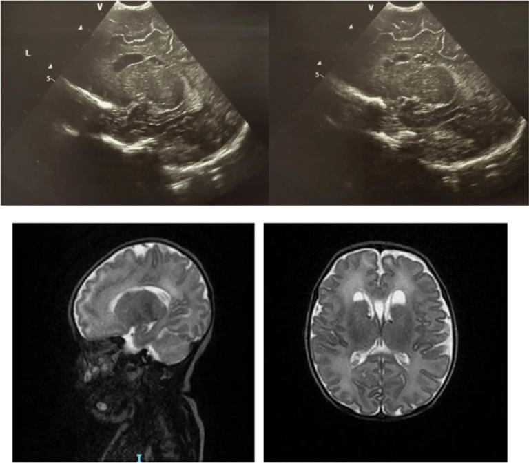Cranial ultrasonographic findings in newborns exposed to SARS-CoV-2: a single-centre cross-sectional analysis