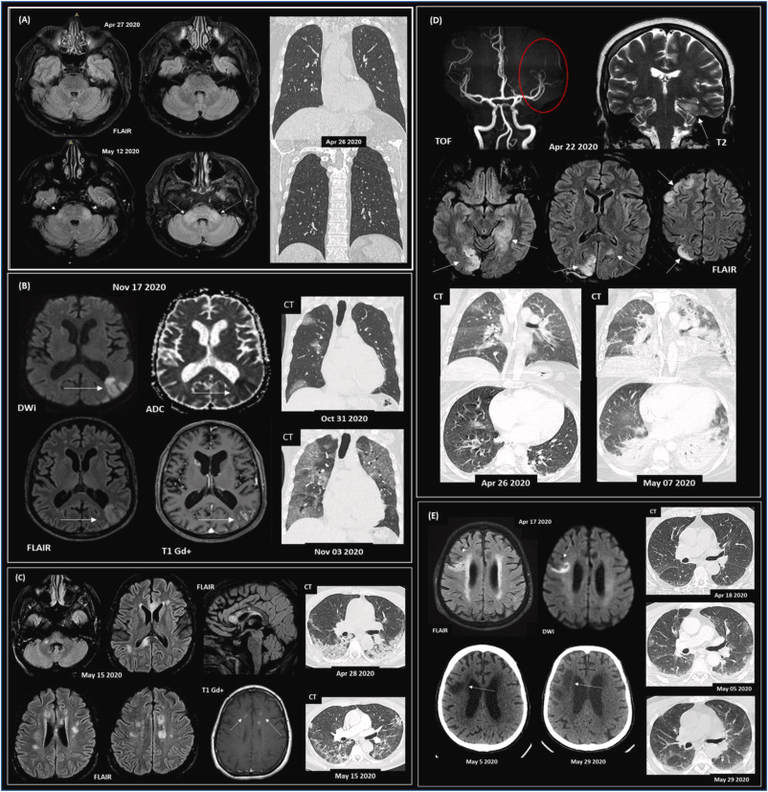 Changes in neuroinflammatory biomarkers correlate with disease severity and neuroimaging alterations in patients with COVID-19 neurological complications