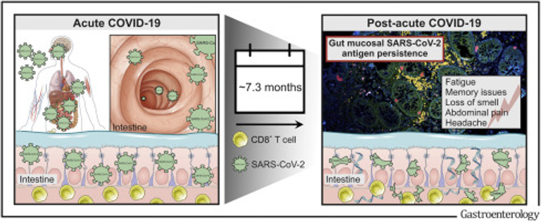 Postacute COVID-19 is Characterized by Gut Viral Antigen Persistence in Inflammatory Bowel Diseases