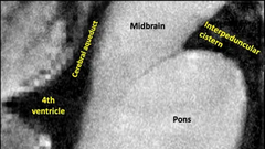 Long COVID or Post-acute Sequelae of COVID-19 (PASC): An Overview of Biological Factors That May Contribute to Persistent Symptoms