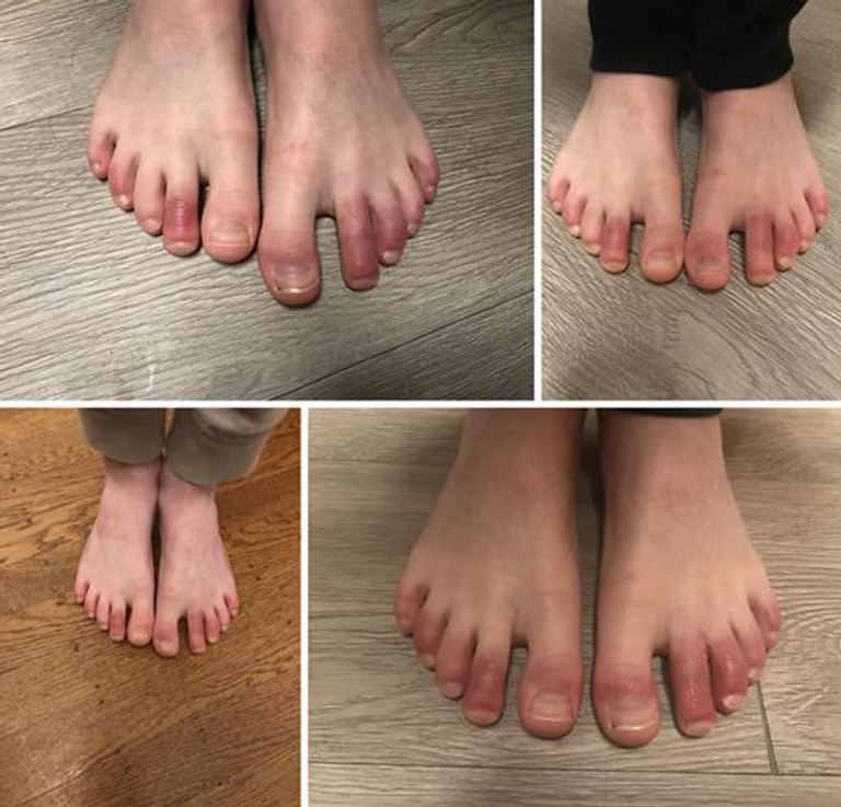 New-Onset OCD and Juvenile Enthesitis-Related Arthritis after COVID-19 (Three Cases)