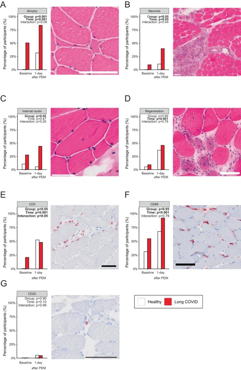 Muscle abnormalities worsen after post-exertional malaise in long COVID