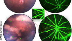 SARS-CoV-2 infects cells lining the blood-retinal barrier and induces a hyperinflammatory immune response in the retina via systemic exposure