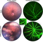 SARS-CoV-2 infects cells lining the blood-retinal barrier and induces a hyperinflammatory immune response in the retina via systemic exposure