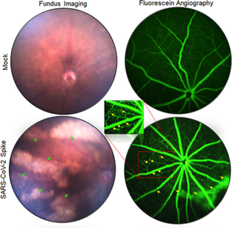 SARS-CoV-2 infects cells lining the blood-retinal barrier and induces a hyperinflammatory immune response in the retina via systemic exposure