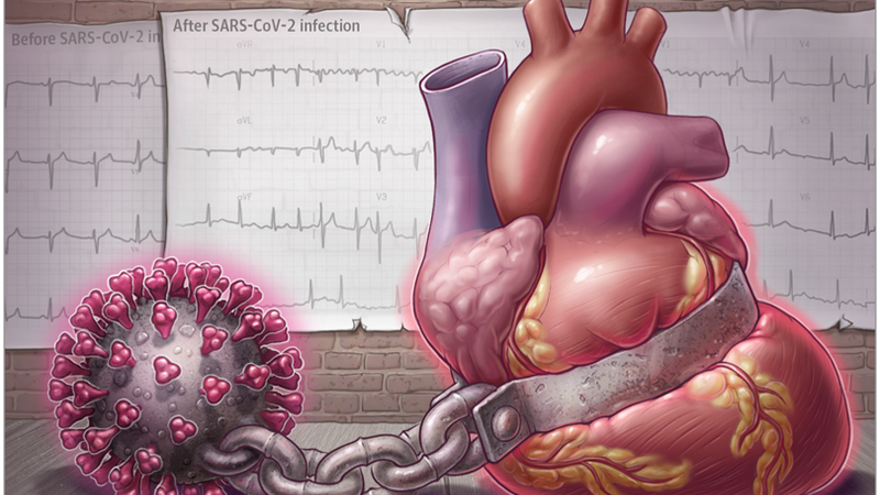 New Guidance on Cardiovascular Disease and COVID-19—From Infection to Long COVID to Vaccination