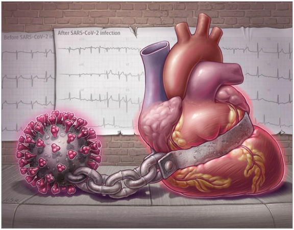 New Guidance on Cardiovascular Disease and COVID-19—From Infection to Long COVID to Vaccination