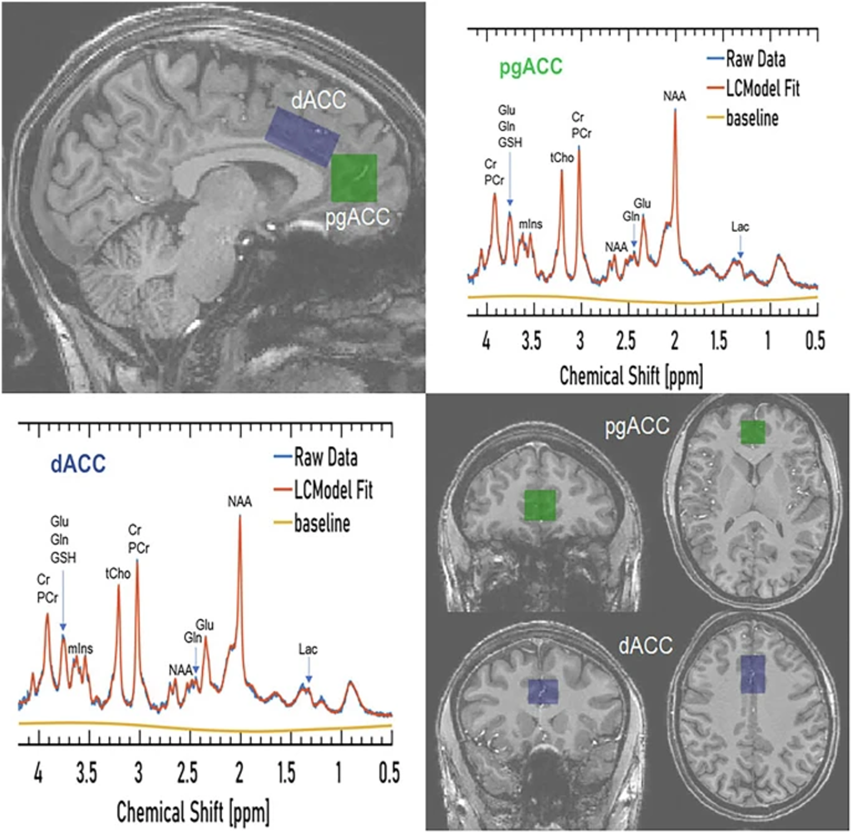 Brain and muscle chemistry in myalgic encephalitis/chronic fatigue syndrome (ME/CFS) and long COVID: a 7T magnetic resonance spectroscopy study