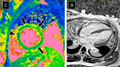 Myocardite et maladie à COVID-19 : où en est-on ?