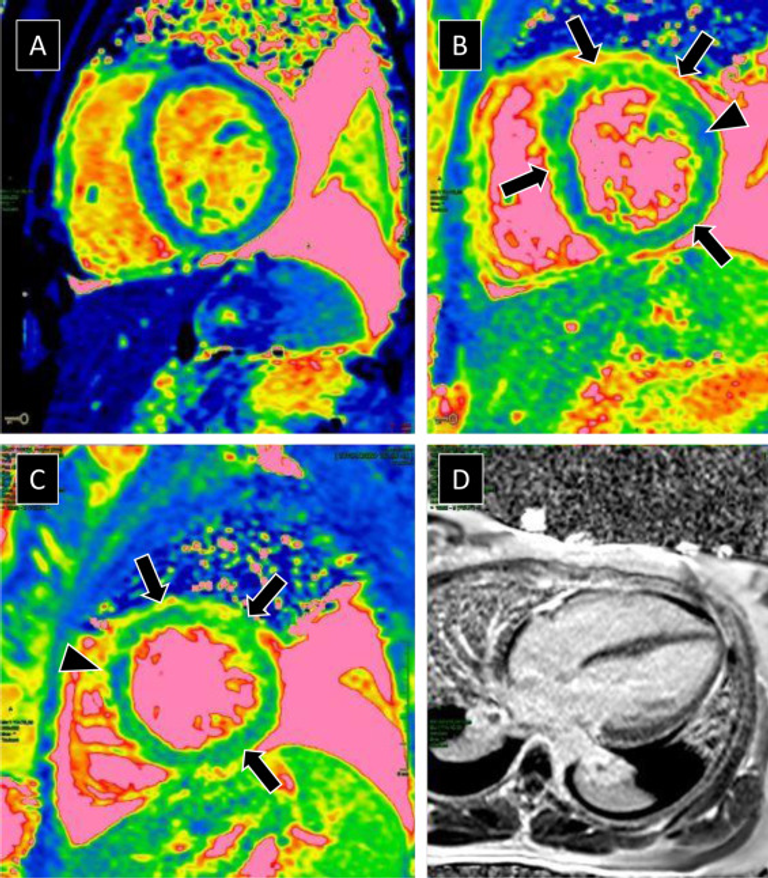 Myocardite et maladie à COVID-19 : où en est-on ?