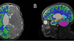 The COVID generation: the neurodevelopmental consequences of in-utero COVID-19 exposure