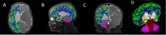 The COVID generation: the neurodevelopmental consequences of in-utero COVID-19 exposure