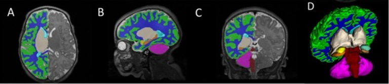 The COVID generation: the neurodevelopmental consequences of in-utero COVID-19 exposure