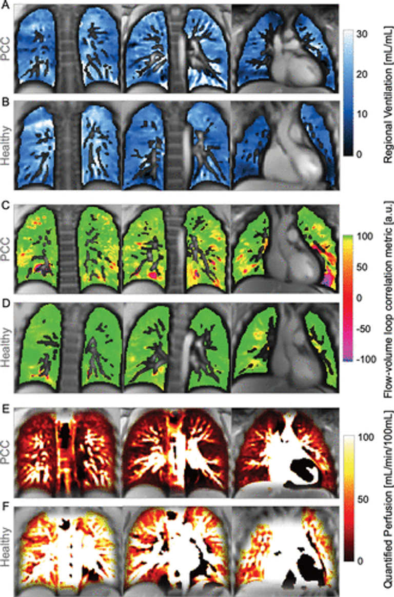 Phase-resolved Functional Lung MRI Reveals Distinct Lung Perfusion Phenotype in Children and Adolescents with Post–COVID-19 Condition