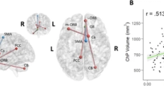 Choroid plexus volume is enlarged in long COVID and associated with cognitive and brain changes