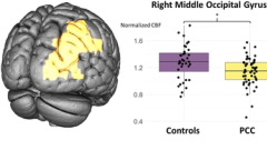 Fatigue in Post-COVID-Condition is accompanied by hypoperfusion of right-occipital areas