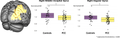Fatigue in Post-COVID-Condition is accompanied by hypoperfusion of right-occipital areas
