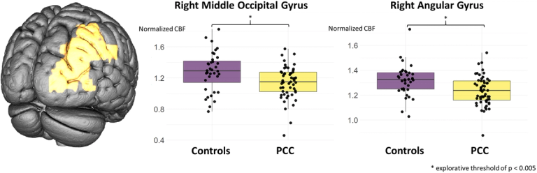 Fatigue in Post-COVID-Condition is accompanied by hypoperfusion of right-occipital areas